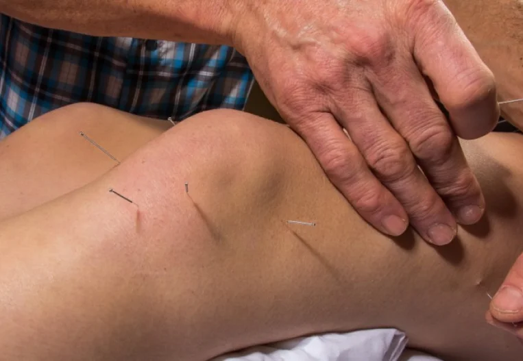 STAR Rehab's Approach to Dry Needling