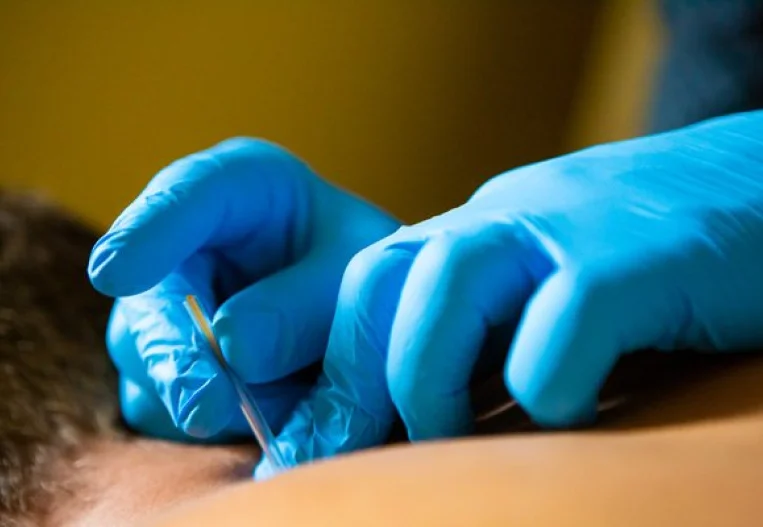 What to Expect During Your Dry Needling Session