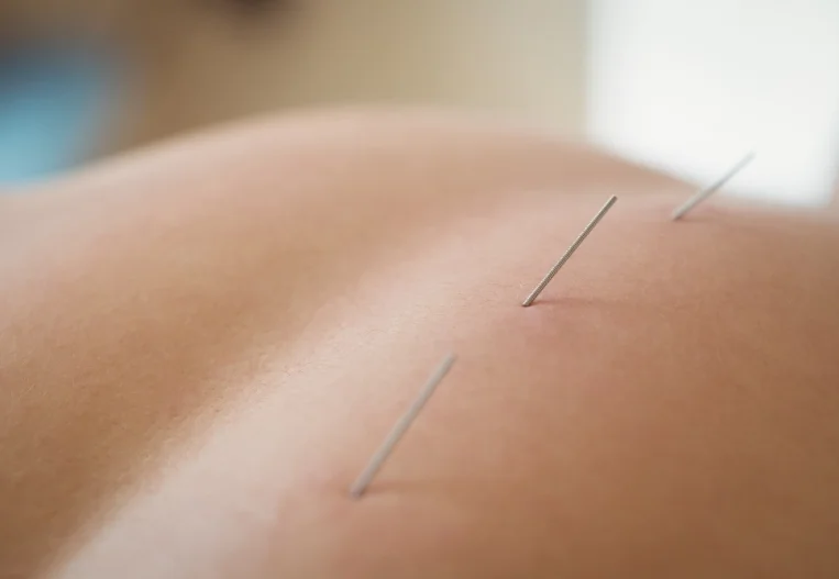 Advanced Pain Relief Through Dry Needling
