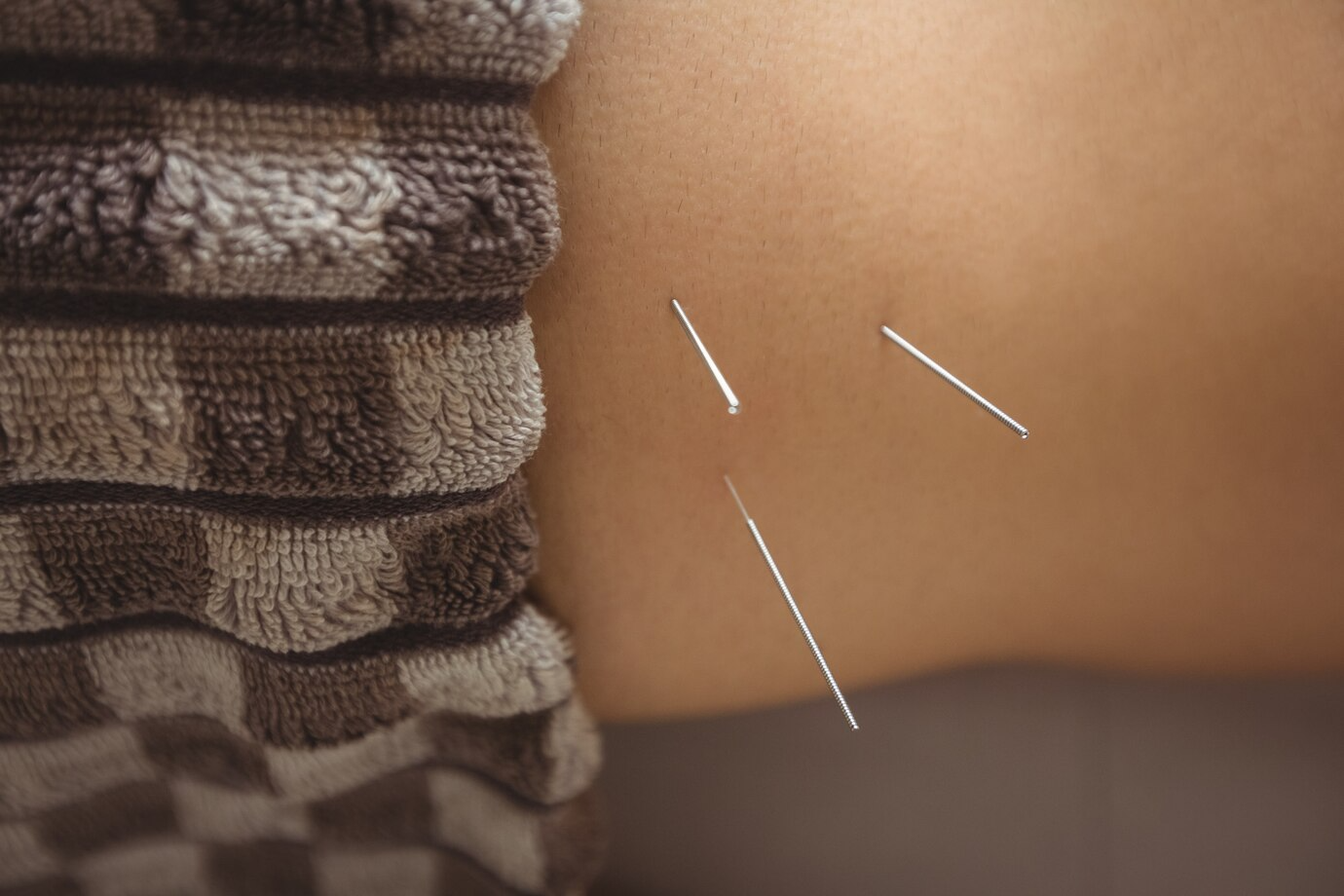 Therapy and Rehabilitation close up patient getting dry needling 107420 65830